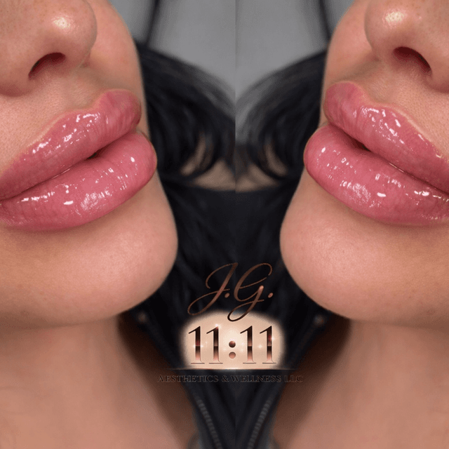 Lip and Chin Package at 1111 Aesthetics & Wellness LLC in Irving, TX